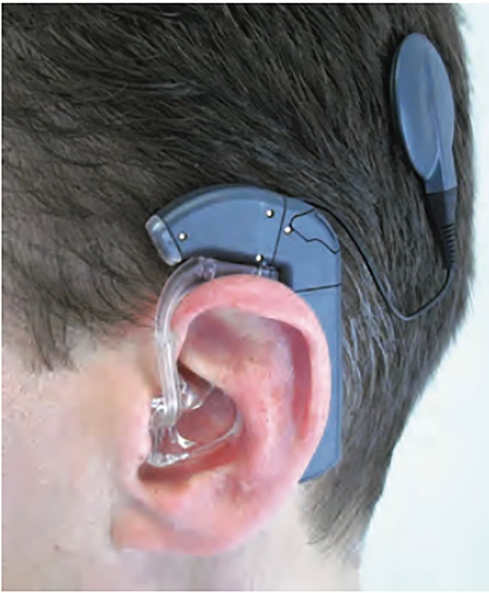 Cochlear Implant | Canadian Hard of Hearing Association | Sudbury, ON